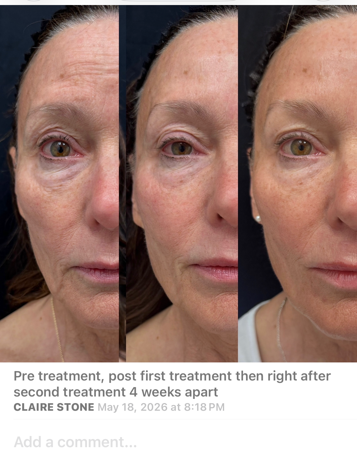 Before and after skin tightening result 6