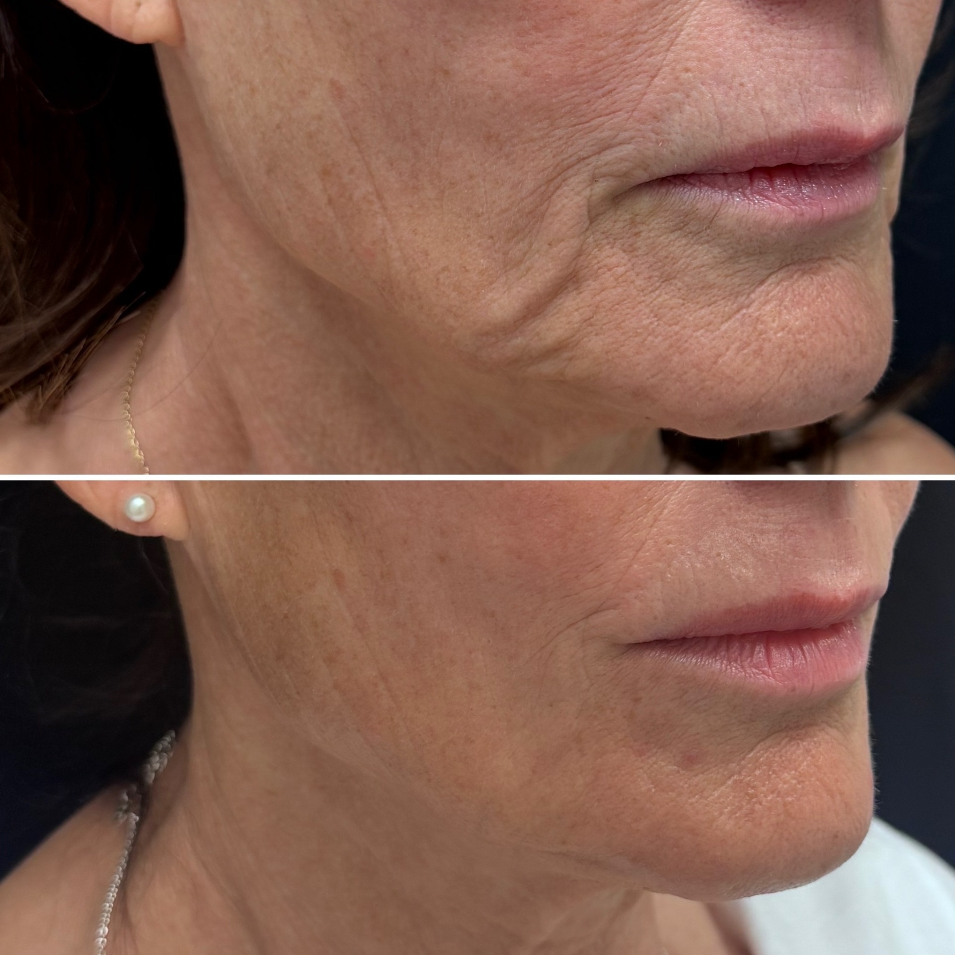 Before and after skin tightening result 3